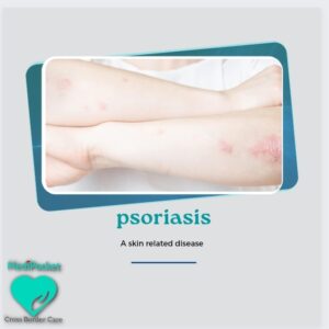 Psoriasis- causes and symptoms￼
