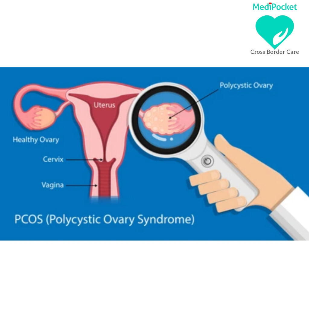 image of uterus with the cyst in the ovary, pcos